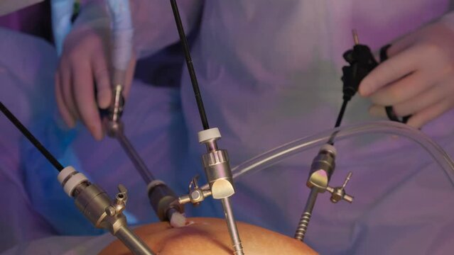 Laparoscopic cholecystectomy instrument. The surgeon's doing laparoscopic gastric sleeve surgery in the operating room