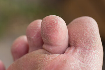 Foot skin Cracked up dead skin peel desquamation medical condition flaking