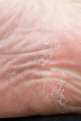 Fototapeta premium Foot skin Cracked up dead skin peel desquamation medical condition flaking