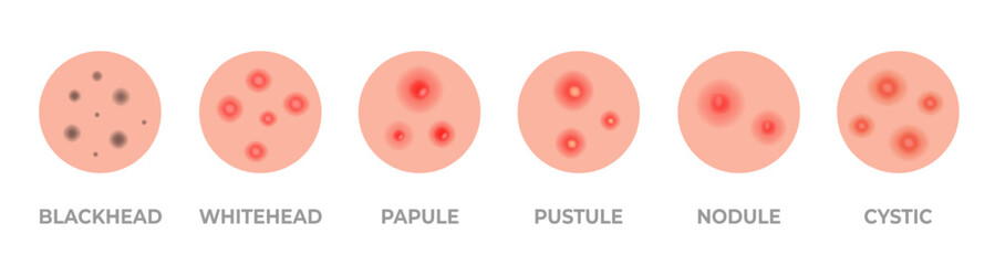 Acne types set. Skin pimples, blackheads and face comedones. Acne skin types - blackheads, whiteheads, papules, pustules, cystic and nodular