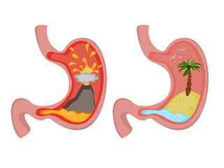 Fototapeta premium Before and after heartburn treatment. Erupting volcano as acid indigestion and island in ocean as healthy condition, stomach illustrations on white background. Gastroesophageal reflux disease
