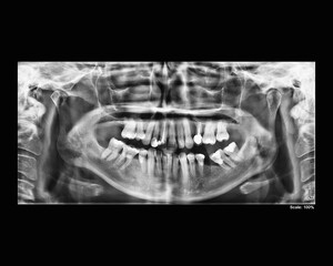 Dental panoramic x-ray of adult woman