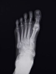 Female adult left foot x-ray in subjtive superior view . 