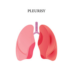 Vector pleurisy disease, illustration design for medical