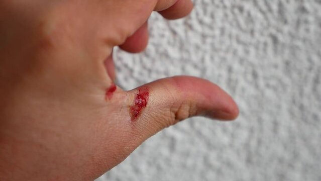 work accident a human hand injured after a work accident, hand injuries,