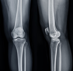 Film x-ray  of Left knee joint  AP and Lateral view  for diagnosis knee pain from osteoarthritis...