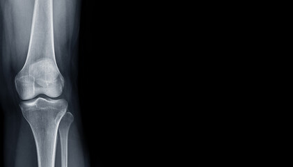 Film x-ray  of Left knee joint  AP view  for medical background.