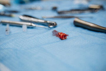 A pulled tooth lies in blood on the table in the operating room