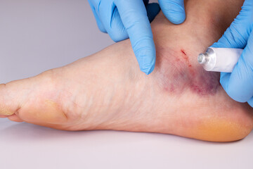 Doctors hands in gloves smear medicinal ointment to bruise on the patients leg