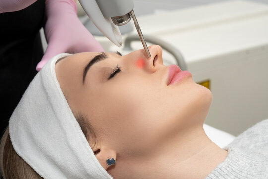 Close-up removal of blood vessels on the nose and face with a medical laser in a cosmetic clinic. Treatment of blood vessels in the nose.