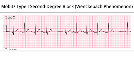 Wenckebach Phenomenon - ECG Mobitz Type 1 Second Degree Atrioventricular Block - 2nd degree AV Block - 8 Second ECG Paper - Electrocardiography Vector Medical Illustration - obrazy, fototapety, plakaty