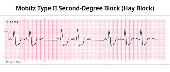 Hay Block - ECG Mobitz Type 2 Second Degree Atrioventricular Block - 2nd degree AV Block - 8 Second ECG Paper - Electrocardiography Vector Medical Illustration