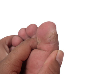 Selective focus on the callus on the big toe, soft focus
