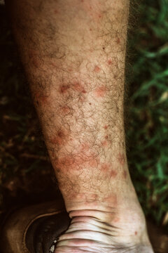 Close up of insect bites on leg of man