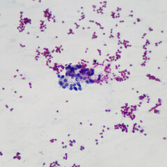 Camera photo of papillary thyroid carcinoma showing intranuclear pseudoinclusion in neoplastic follicular cells, magnification 400x, photograph through a microscope