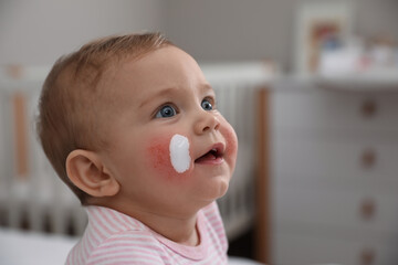 Cute little baby with anti-allergic cream on her cheeks at home, closeup and space for text....
