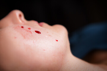 Drops of blood on the face of a woman after cosmetic procedures in a beauty salon. Anti aging treatment. Skin care and rejuvenation treatments.
