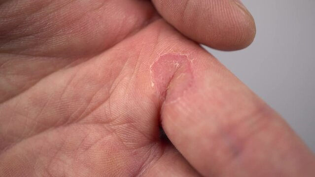 Wart on a mans finger closeup Large callus