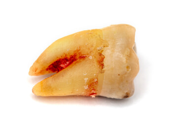 Close up shot of a molar tooth decay extracted and placed on a white background. The root of the tooth is not long, there is a small amount of bleeding.   Selective focus.