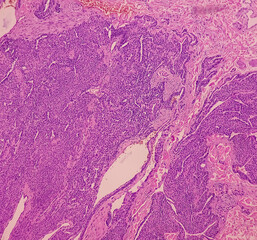 Cutaneous nodule (biopsy). Photomicrograph of glomangioma of skin. Microscopically show solid and syncytial proliferation of round cells, necrosis and nuclear atypia present. Glomus tumor. - obrazy, fototapety, plakaty