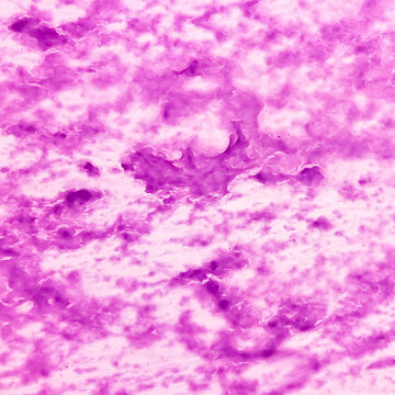 Scalp swelling cytology: Epidermal inclusion cyst. commonly called "sebaceous cyst". Showing anucleated squames only, no malignancy.