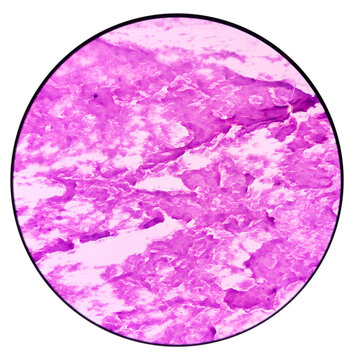 Scalp swelling cytology: Epidermal inclusion cyst. commonly called "sebaceous cyst". Showing anucleated squames only, no malignancy.
