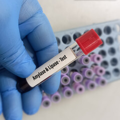 Biochemist or Lab Technologist holds Blood sample for Amylase and Lipase enzyme test. Diagnosis of...