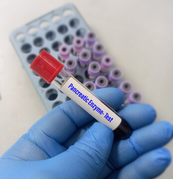 Blood sample for Pancreatic enzyme test, to diagnosis of pancreatitis. Amylase and lipase test.
