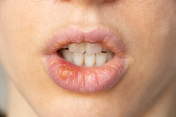 Simplex herpes on the lips of a girl close-up, a group of viral diseases with a characteristic rash...