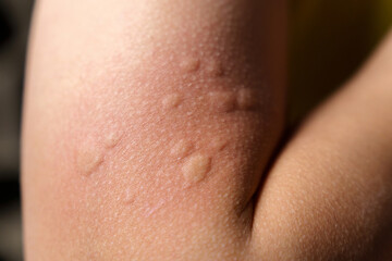 Skin texture, allergy shot, weeds, reaction. Allergy symptoms. Selective focus