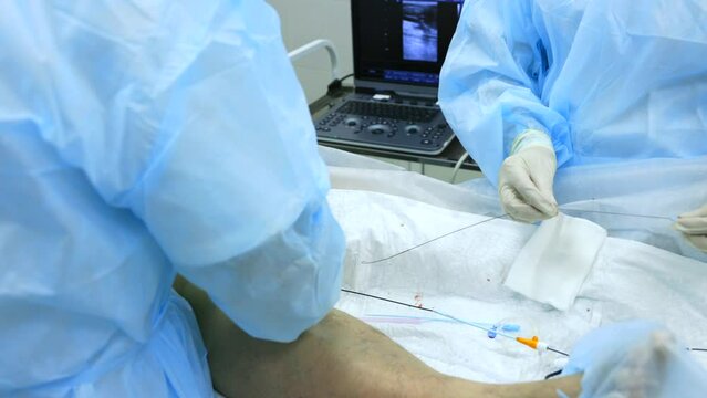 Introduction through small puncture radiofrequency catheter with special sensor for treatment varicose veins. Radiofrequency ablation of the veins of lower extremities by an experienced phlebologist