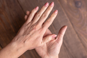 Extremely dry, dehydrated and cracked skin of a woman's hand. Allergy, inflammatory process. Eczema, atopic dermatitis, lichen, allergy, itching, urticaria, psoriasis