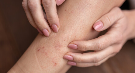 A red rash caused by allergy, inflammatory process. Eczema, atopic dermatitis, lichen, allergy, itching, urticaria, psoriasis