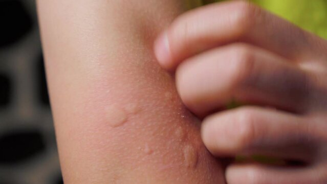 Allergy symptoms, after injection. Edematous part, red puncture site.