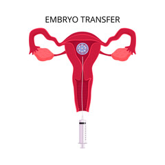 Embryo Transfer Flat Composition