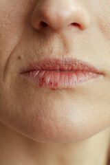 Closeup on woman with herpes on lips on beige background