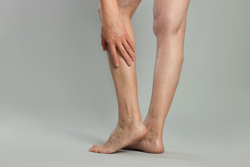 Closeup view of woman with varicose veins on light grey background