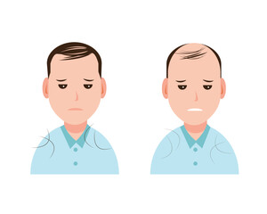 Male pattern baldness, alopecia, type of hair loss in men vector isolated on white background. Step of hair losing  to alopecia. Hair problem concept illustration.