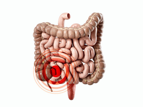 3d illustration of human internal organ - intestine. Sick intestine concept