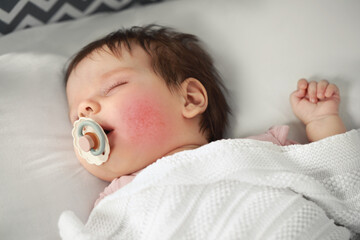 Cute little baby with allergic redness sleeping on cosy bed, closeup