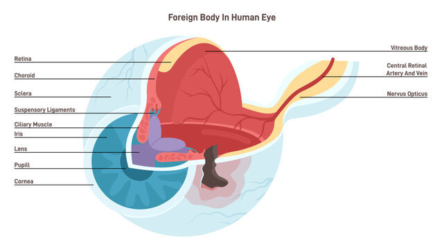 Human eye injured by foreign object. Ophthalmological problem