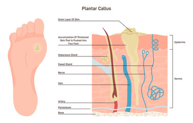 Feet plantar callus. Swollen skin with rough, yellowing patch of lumpy © inspiring.team