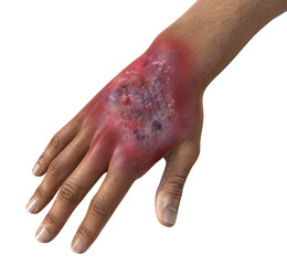 Protothecosis infection on human hand, 3D illustration