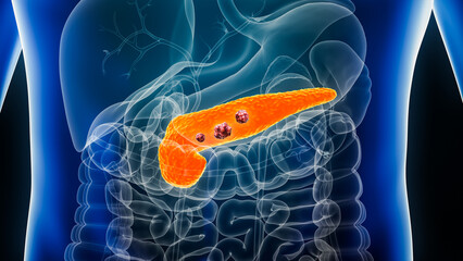 Pancreas or pancreatic cancer with organs and tumors or cancerous cells 3D rendering illustration with male body. Anatomy, oncology, disease, medical, biology, science, healthcare concepts. - obrazy, fototapety, plakaty