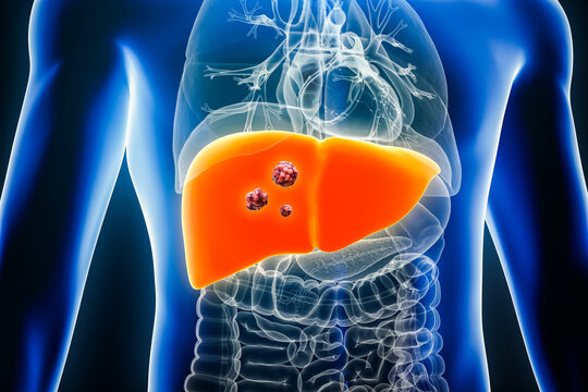 Liver cancer with organs and tumors or cancerous cells 3D rendering illustration. Anatomy, oncology, biomedical, disease, medical, biology, science, healthcare concepts.