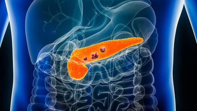 Pancreas or pancreatic cancer with organs and tumors or cancerous cells 3D rendering illustration with male body. Anatomy, oncology, disease, medical, biology, science, healthcare concepts.
