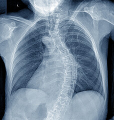X-ray of the human chest organs, C-shaped scoliotic deformity of the spinal column - obrazy, fototapety, plakaty
