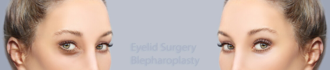 Lower and upper Blepharoplasty.Marking the face.Perforation lines on females face, plastic surgery concept.