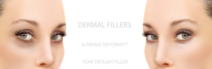  Tear Trough Filler,A-frame deformity. Fat grafting or dermal filler treatments .Hyaluronic acid injections for specific areas.