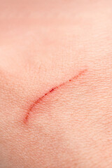 Close-up scratch on the skin